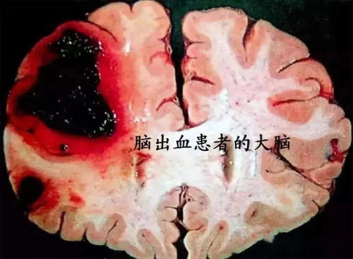 女生突发脑出血 症状是不会说英语(女生突发脑出血与语言障碍，不会说英语的紧急症状)